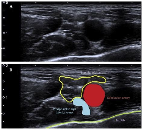 ultrasound for thoracic outlet syndrome